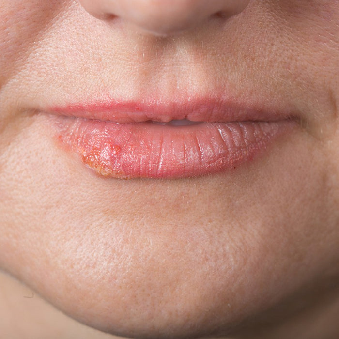 Cold sore causes prevention treatment in winter