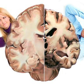 Could you be showing signs of early Alzheimer's?